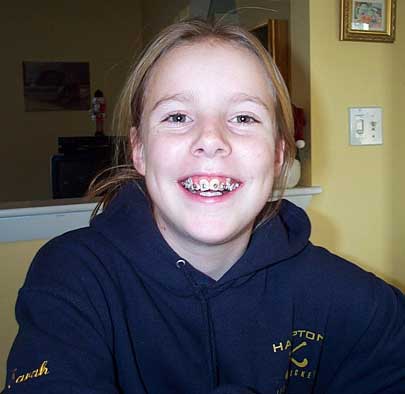 Sarah with the start of her braces.